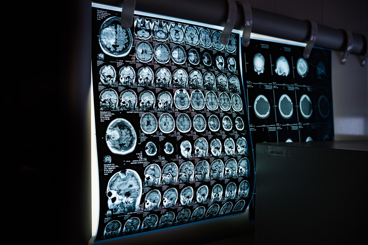 자동차보험 mri 비급여